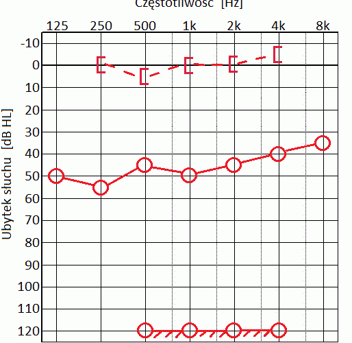Audiogram przy ubytku przewodzeniowym